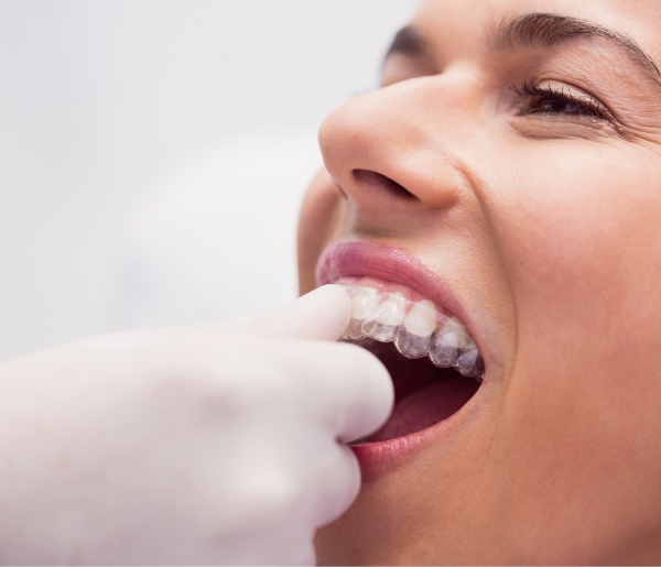 Брекеты и элайнеры